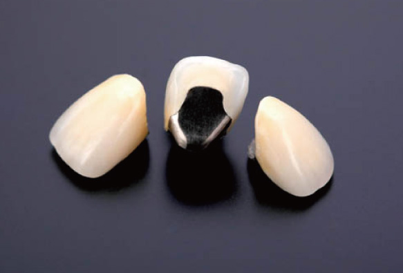 ジルコニアクラウン メタルボンド（陶材冠）