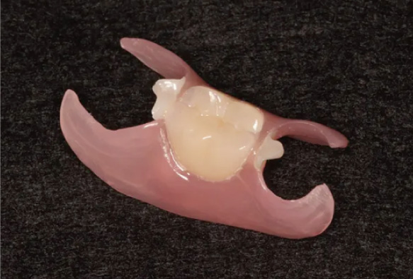 ノンクラスプ審美義歯