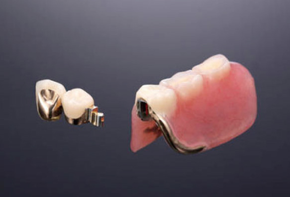 各種アタッチメント義歯<br> (はりがねを隠した義歯)